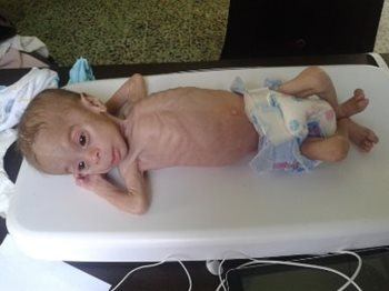 Munir est arrivé à la clinique de malnutrition du Croissant‑Rouge arabe syrien dans la ville d’Al Tal, à Damas-Campagne, il était si fragile que les médecins étaient incapables de le mesurer