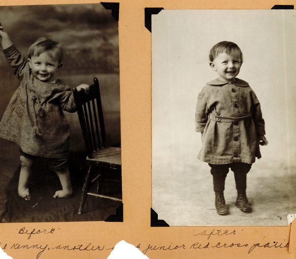A “before and after” image of “Kenny” whose treatment for club feet was paid for by the Junior Red Cross “Crippled Children’s Fund,” ca. 1920s-1930s-FR