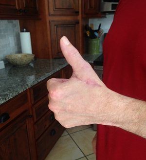 thumbs-up-after-saw-accident-(1).JPG